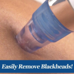 4-in-1 Blackhead Remover Vacuum Cleaner | Electric Pore Cleaner & Acne Extractor - Image 3